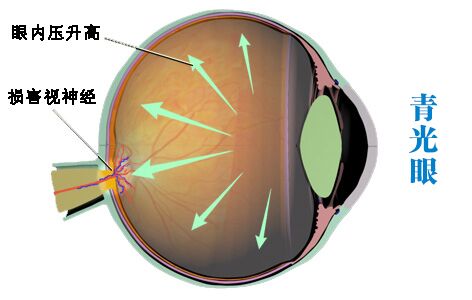 患青光眼為什么會(huì)致盲?
