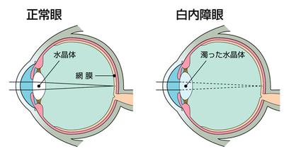 【掃盲帖】白內(nèi)障常識，一看就會！