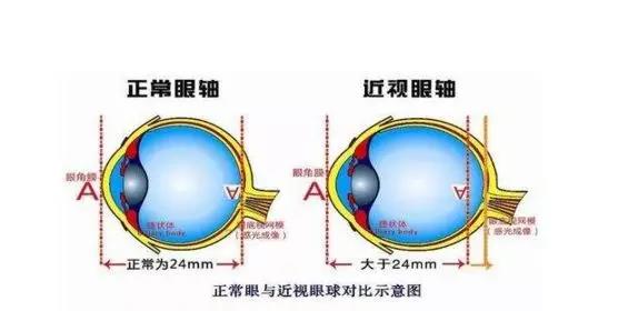 近視手術(shù)能解決眼睛變形、眼球突出的問(wèn)題嗎？